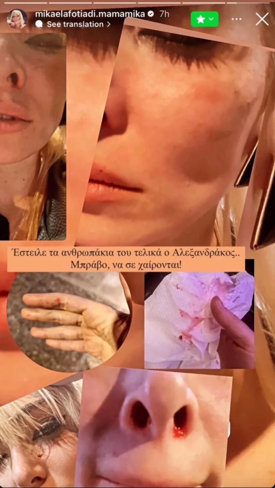 Μικαέλα Φωτιάδη ξυλοδαρμός